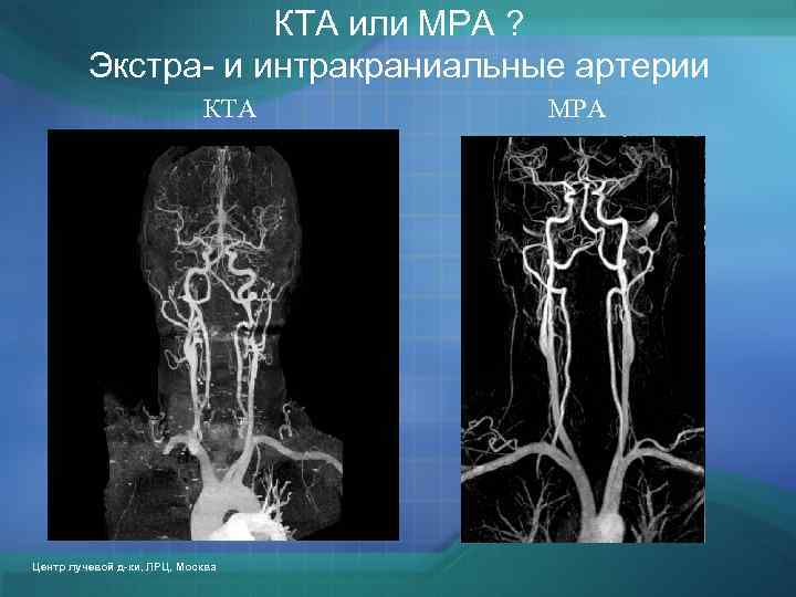 КТА или МРА ? Экстра- и интракраниальные артерии КТА Центр лучевой д-ки, ЛРЦ, Москва
