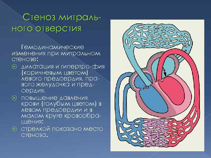 Стеноз митрального отверстия Гемодинамические изменения при митральном стенозе: ⦿ дилатация и гипертро-фия (коричневым цветом)