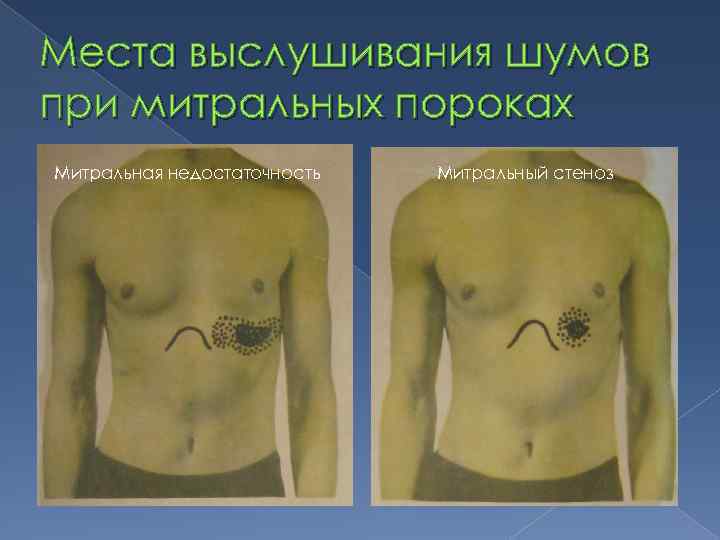 Места выслушивания шумов при митральных пороках Митральная недостаточность Митральный стеноз 