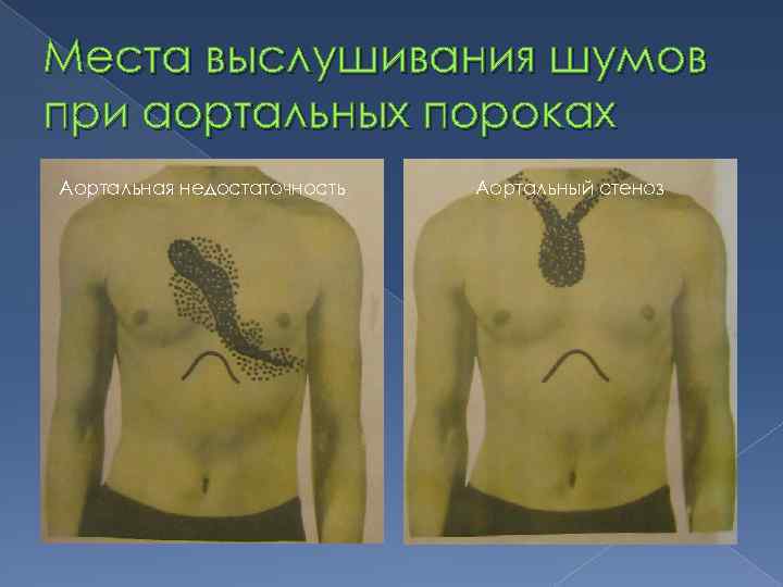 Места выслушивания шумов при аортальных пороках Аортальная недостаточность Аортальный стеноз 