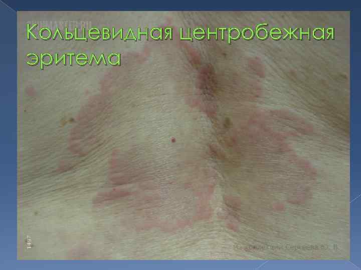 Кольцевидная центробежная эритема 