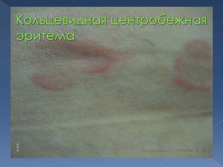 Кольцевидная центробежная эритема 
