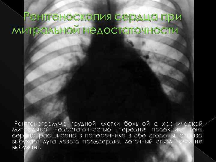 Рентгеноскопия сердца при митральной недостаточности Рентгенограмма грудной клетки больной с хронической митральной недостаточностью (передняя
