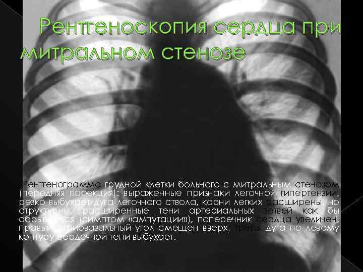 Рентгеноскопия сердца при митральном стенозе Рентгенограмма грудной клетки больного с митральным стенозом (передняя проекция):