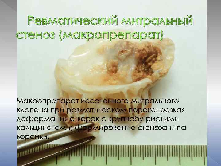 Ревматический митральный стеноз (макропрепарат) Макропрепарат иссеченного митрального клапана при ревматическом пороке: резкая деформация створок