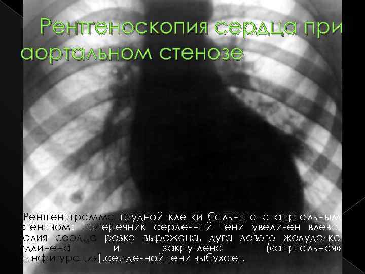 Рентгеноскопия сердца при аортальном стенозе Рентгенограмма грудной клетки больного с аортальным стенозом: поперечник сердечной