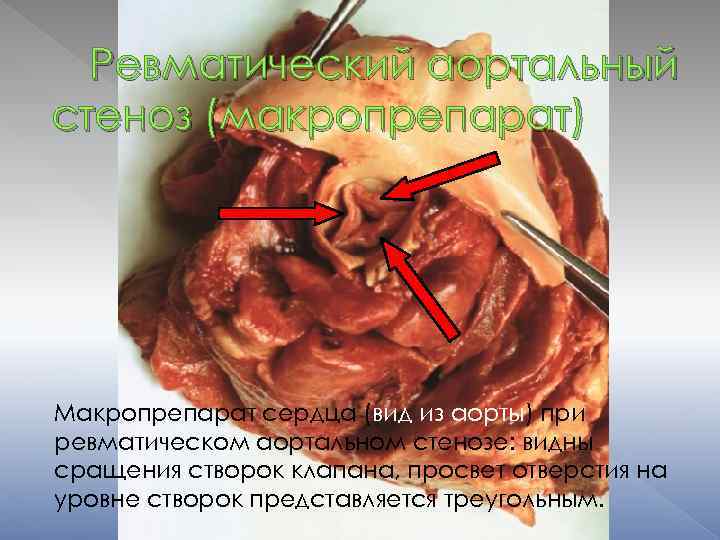 Ревматический аортальный стеноз (макропрепарат) Макропрепарат сердца (вид из аорты) при ревматическом аортальном стенозе: видны