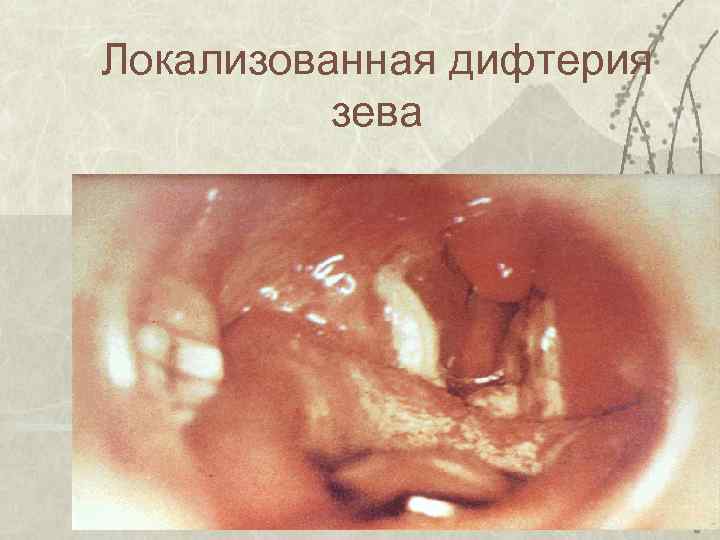 Локализованная дифтерия зева 