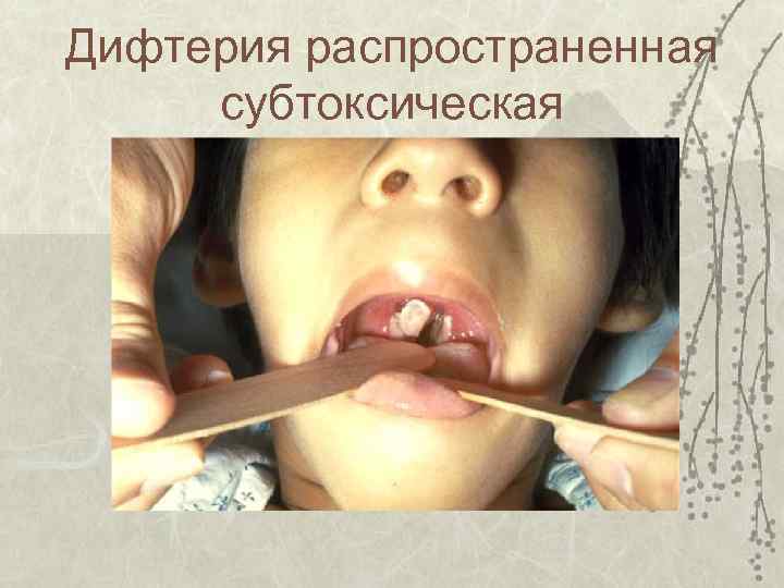 Дифтерия распространенная субтоксическая 
