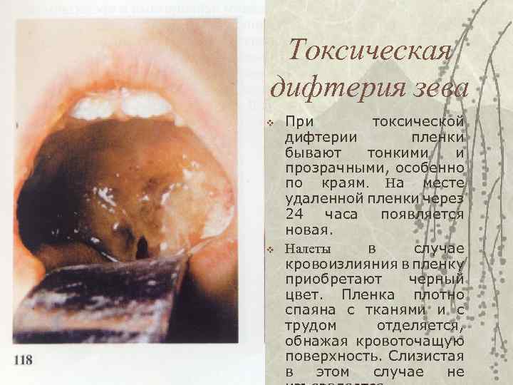 Токсическая дифтерия зева v v При токсической дифтерии пленки бывают тонкими и прозрачными, особенно