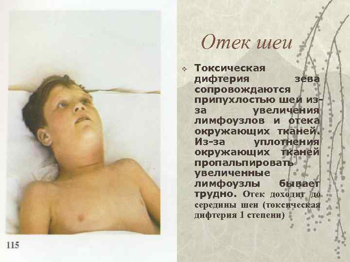 Отек шеи v Токсическая дифтерия зева сопровождаются припухлостью шеи изза увеличения лимфоузлов и отека