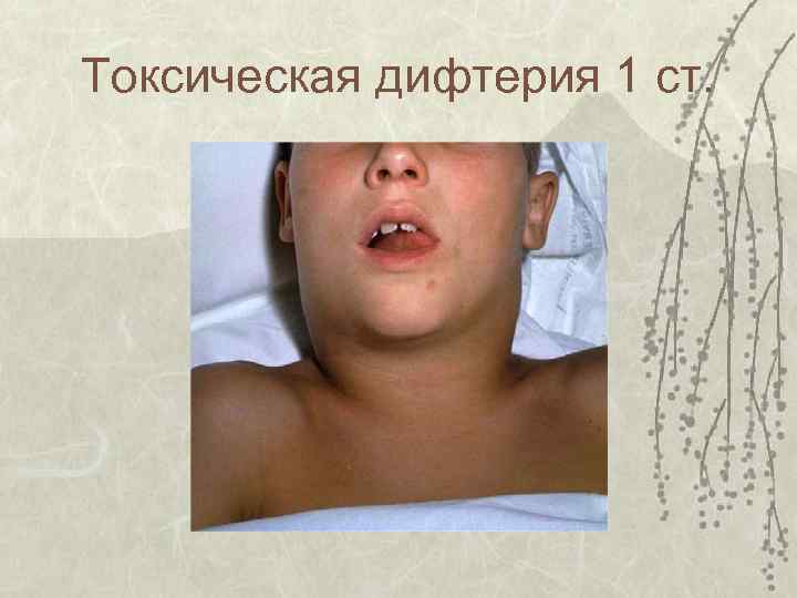 Токсическая дифтерия 1 ст. 