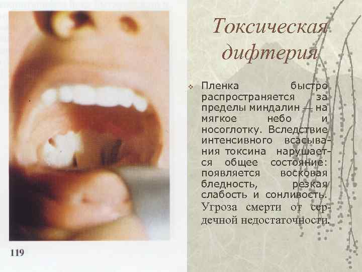 Токсическая дифтерия v Пленка быстро распространяется за пределы миндалин — на мягкое небо и