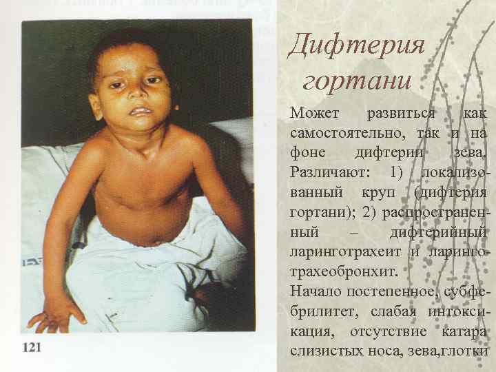 Дифтерия гортани Может развиться как самостоятельно, так и на фоне дифтерии зева. Различают: 1)