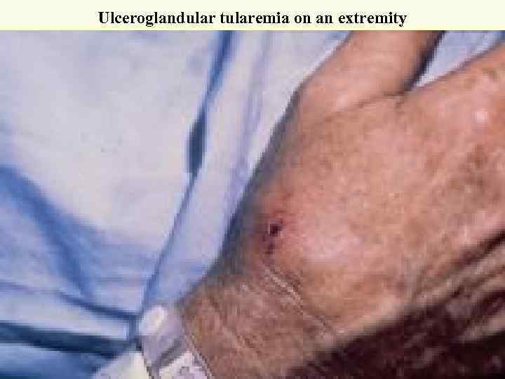 Ulceroglandular tularemia on an extremity Courtesy of Dr Hon 