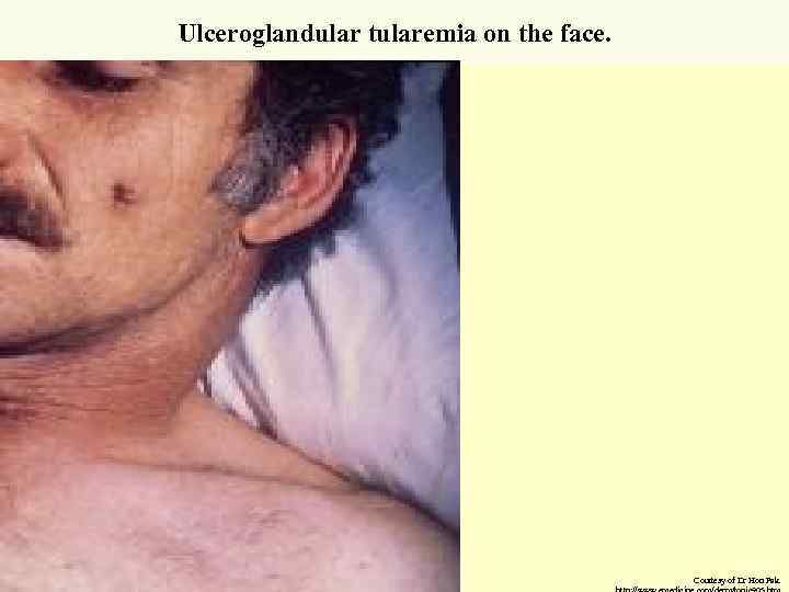 Ulceroglandular tularemia on the face. Courtesy of Dr Hon Pak. 