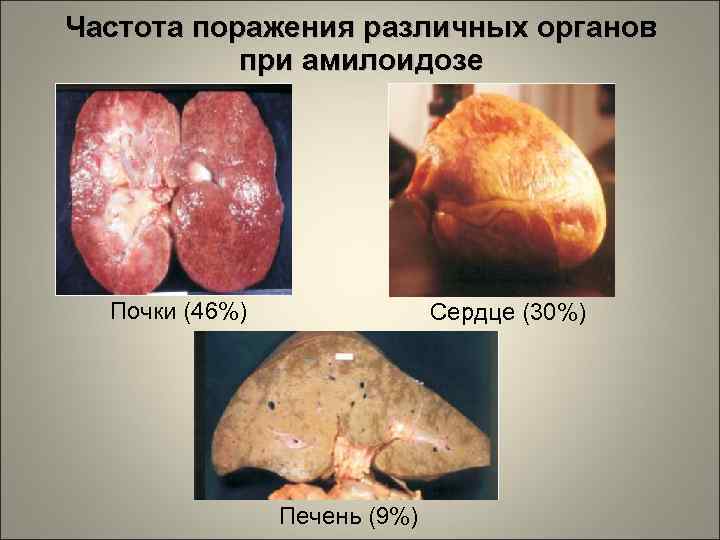 Частота поражения различных органов при амилоидозе Почки (46%) Сердце (30%) Печень (9%) 