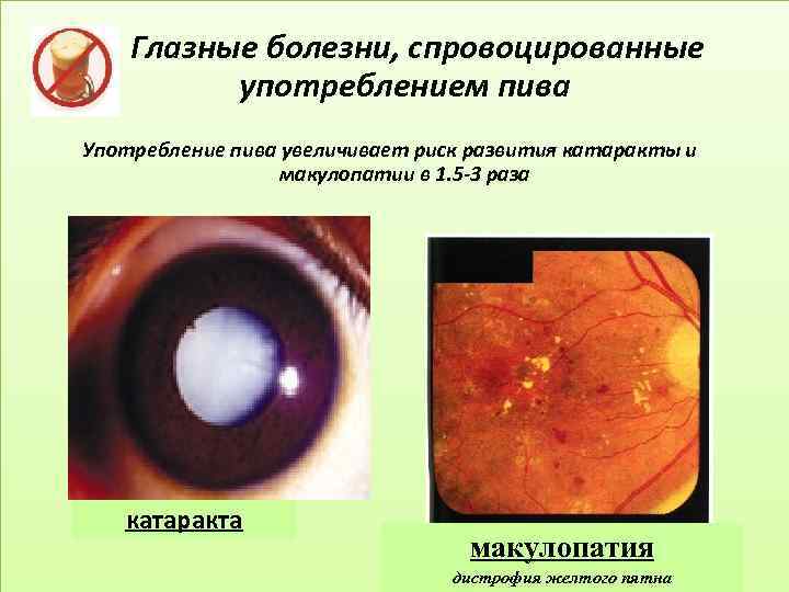 Глазные болезни, спровоцированные употреблением пива Употребление пива увеличивает риск развития катаракты и макулопатии в