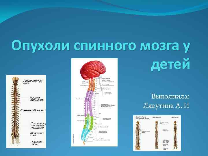 Опухоли спинного мозга у детей Выполнила: Лякутина А. И 