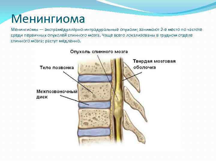 Опухоль спинного мозга. Экстрамедуллярная опухоль спинного мозга симптомы. Опухоль спинного мозга экстрамедуллярная в грудном отделе. Интрадуральная опухоль спинного мозга. Менингиома позвоночника грудного.