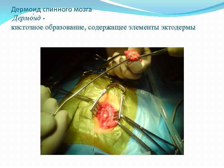 Дермоид спинного мозга Дермо ид - кистозное образование, содержащее элементы эктодермы 