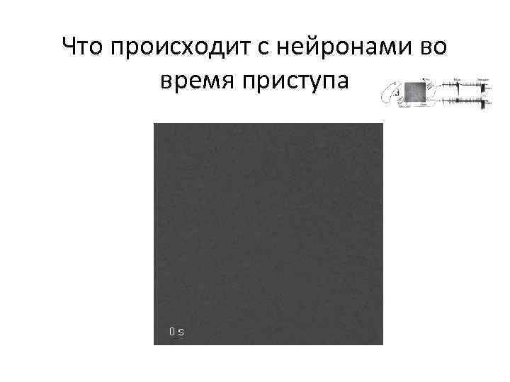 Что происходит с нейронами во время приступа 