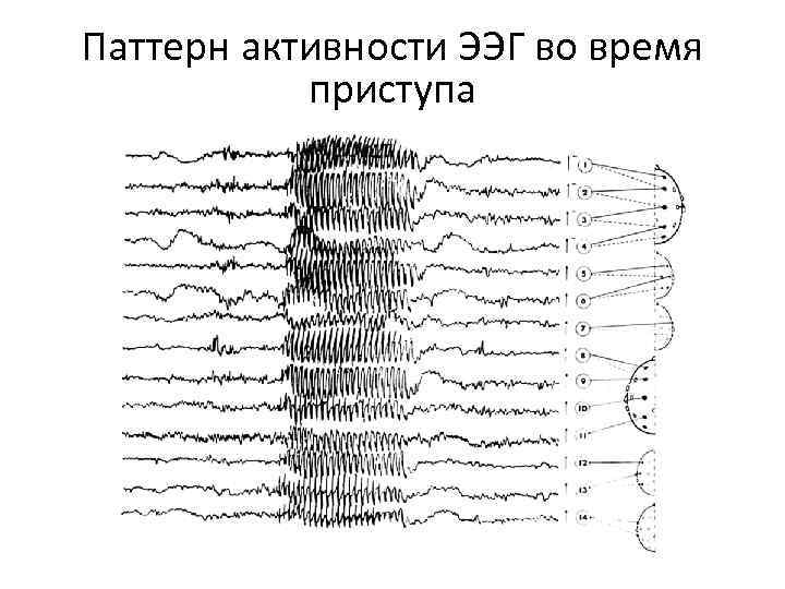 Паттерн активности ЭЭГ во время приступа 