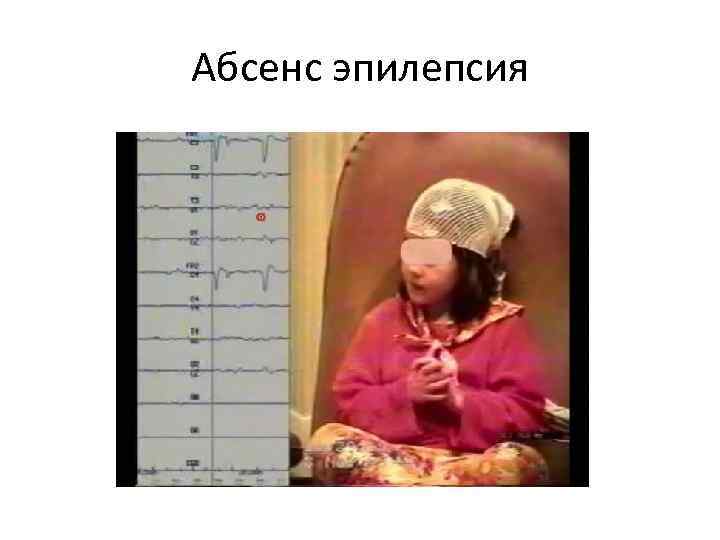 Абсенс эпилепсия 