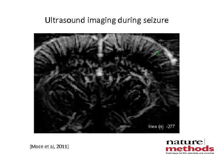 Ultrasound imaging during seizure [Mace et al, 2011] 