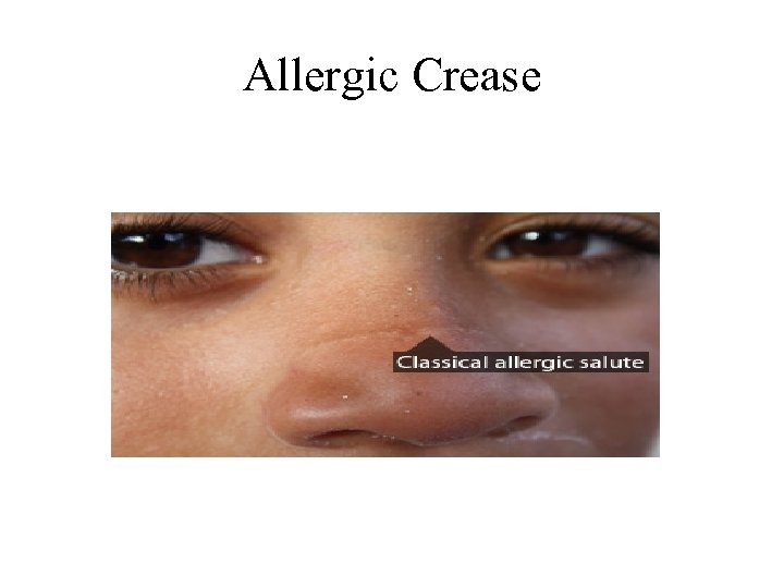 Allergic Crease 