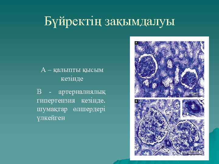 Бүйректің зақымдалуы А – қалыпты қысым кезінде В - артериалиялық гипертензия кезінде. шумақтар өлшердері