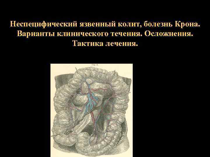 Неспецифический язвенный колит, болезнь Крона. Варианты клинического течения. Осложнения. Тактика лечения. 