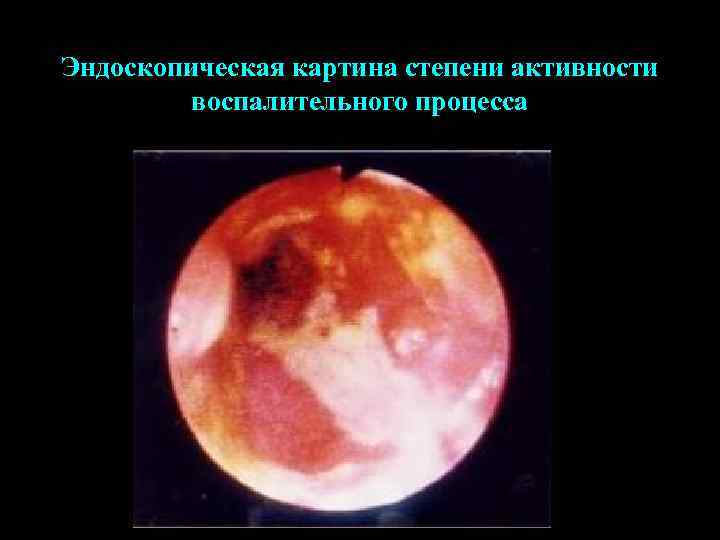 Эндоскопическая картина степени активности воспалительного процесса 