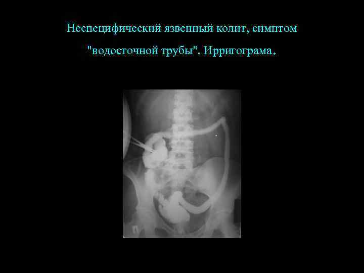 Неспецифический язвенный колит, симптом "водосточной трубы". Ирригограма . 