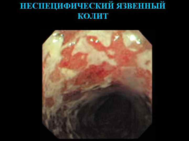 НЕСПЕЦИФИЧЕСКИЙ ЯЗВЕННЫЙ КОЛИТ 