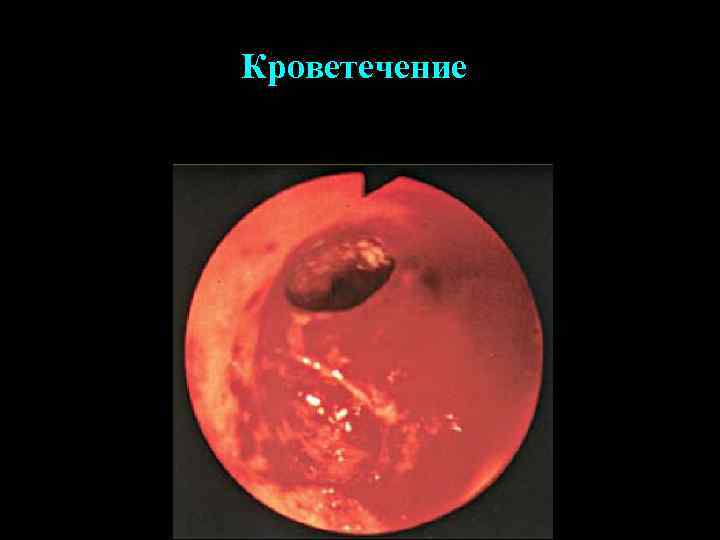 Кроветечение 