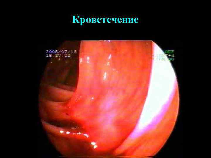 Кроветечение 