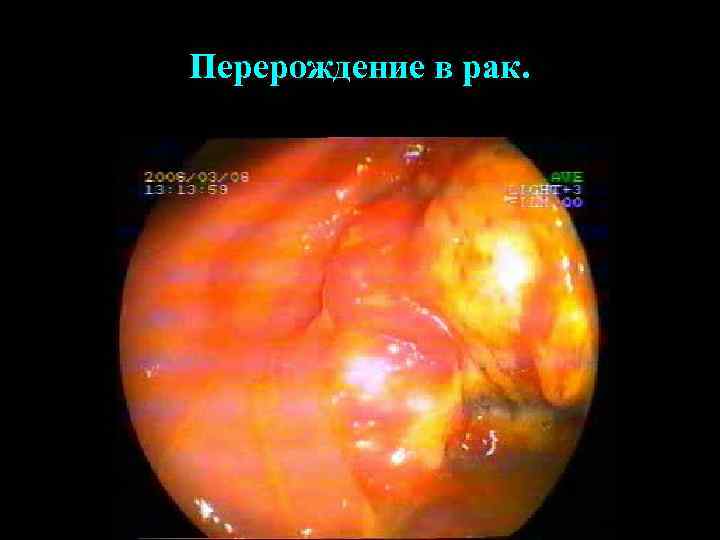 Перерождение в рак. 