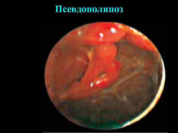 Псевдополипоз 