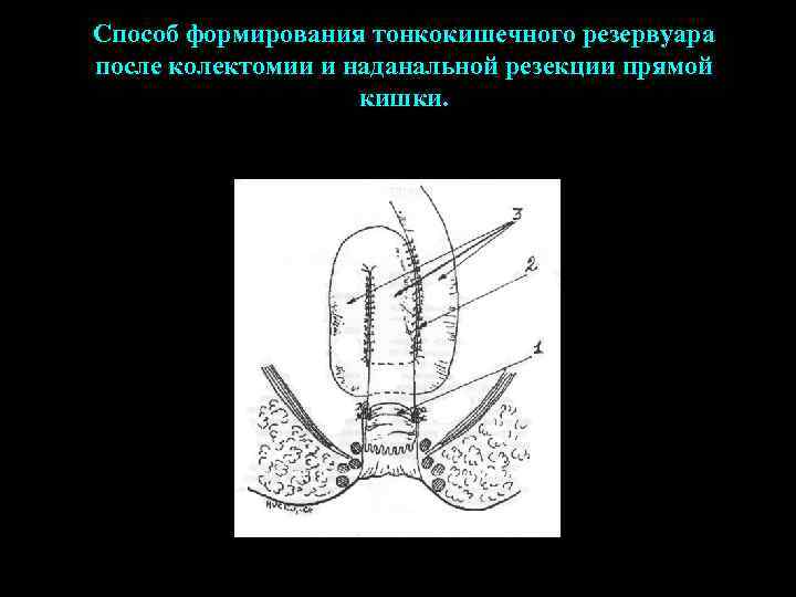 Способ формирования тонкокишечного резервуара после колектомии и наданальной резекции прямой кишки. 