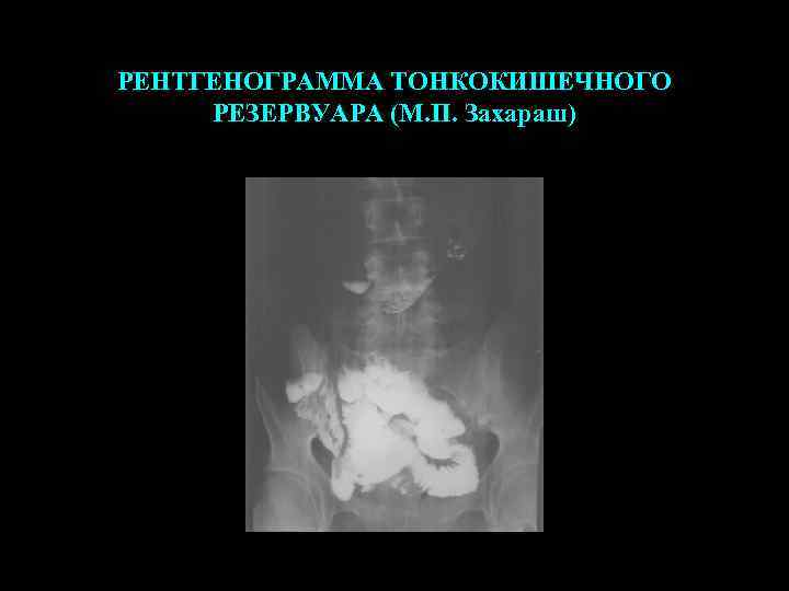 РЕНТГЕНОГРАММА ТОНКОКИШЕЧНОГО РЕЗЕРВУАРА (М. П. Захараш) 