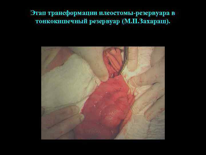 Этап трансформации илеостомы-резервуара в тонкокишечный резервуар (М. П. Захараш). 
