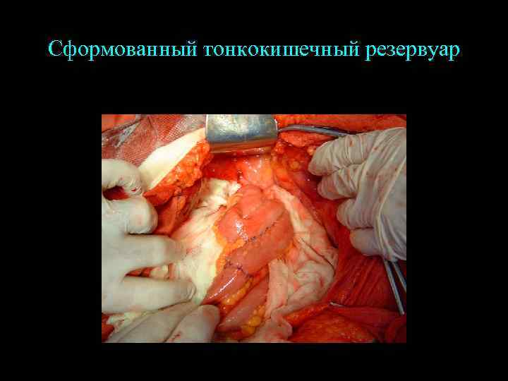 Сформованный тонкокишечный резервуар 