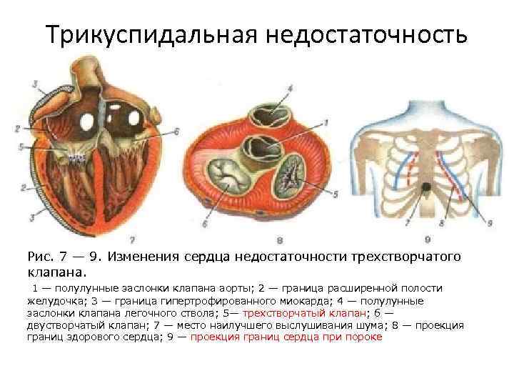 Недостаточность трикуспидального клапана степени