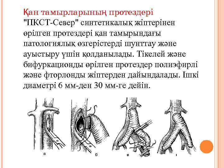 Қан тамырларының протездері "ПКСТ-Север" синтетикалық жіптерінен өрілген протездері қан тамырындағы патологиялық өзгерістерді шунттау және