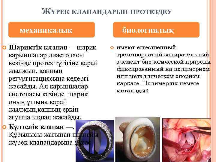 ЖҮРЕК КЛАПАНДАРЫН ПРОТЕЗДЕУ механикалық Шариктік клапан —шарик қарыншалар диастоласы кезінде протез түтігіне қарай жылжып,