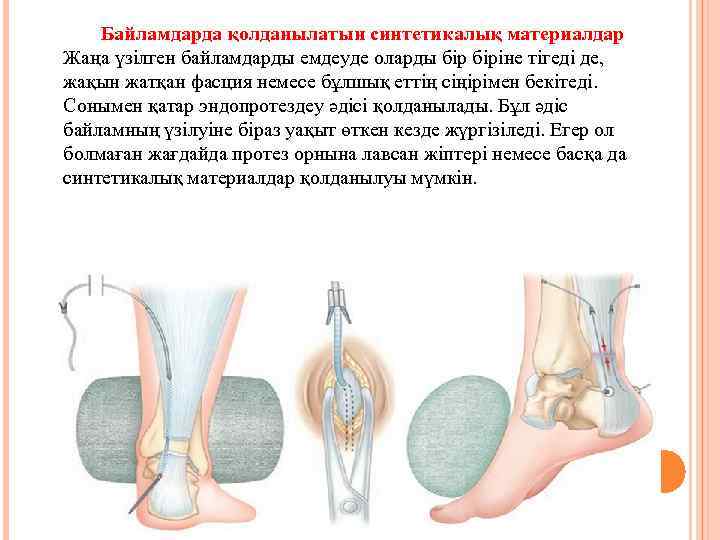 Байламдарда қолданылатын синтетикалық материалдар Жаңа үзілген байламдарды емдеуде оларды біріне тігеді де, жақын жатқан