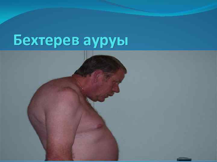 Бехтерев ауруы 