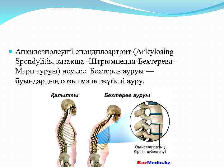  Анкилозирлеуші спондилоартрит (Ankylosing Spondylitis, қазақша -Штрюмпелля-Бехтерева. Мари ауруы) немесе Бехтерев ауруы — буындардың