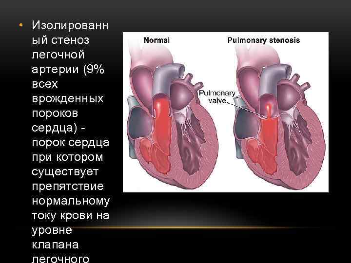  • Изолированн ый стеноз легочной артерии (9% всех врожденных пороков сердца) - порок